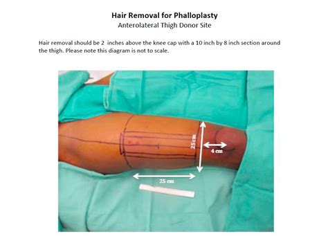 faloplastia|Phalloplasty Guide: How to Prepare & What to Expect